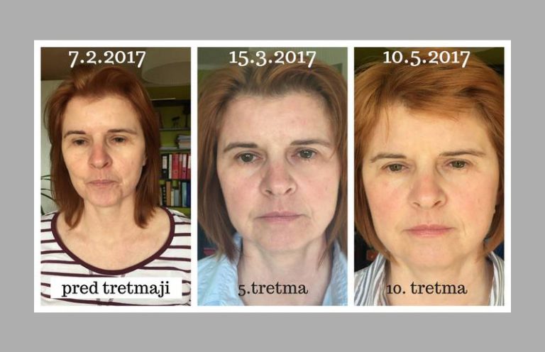 Access facelift схема